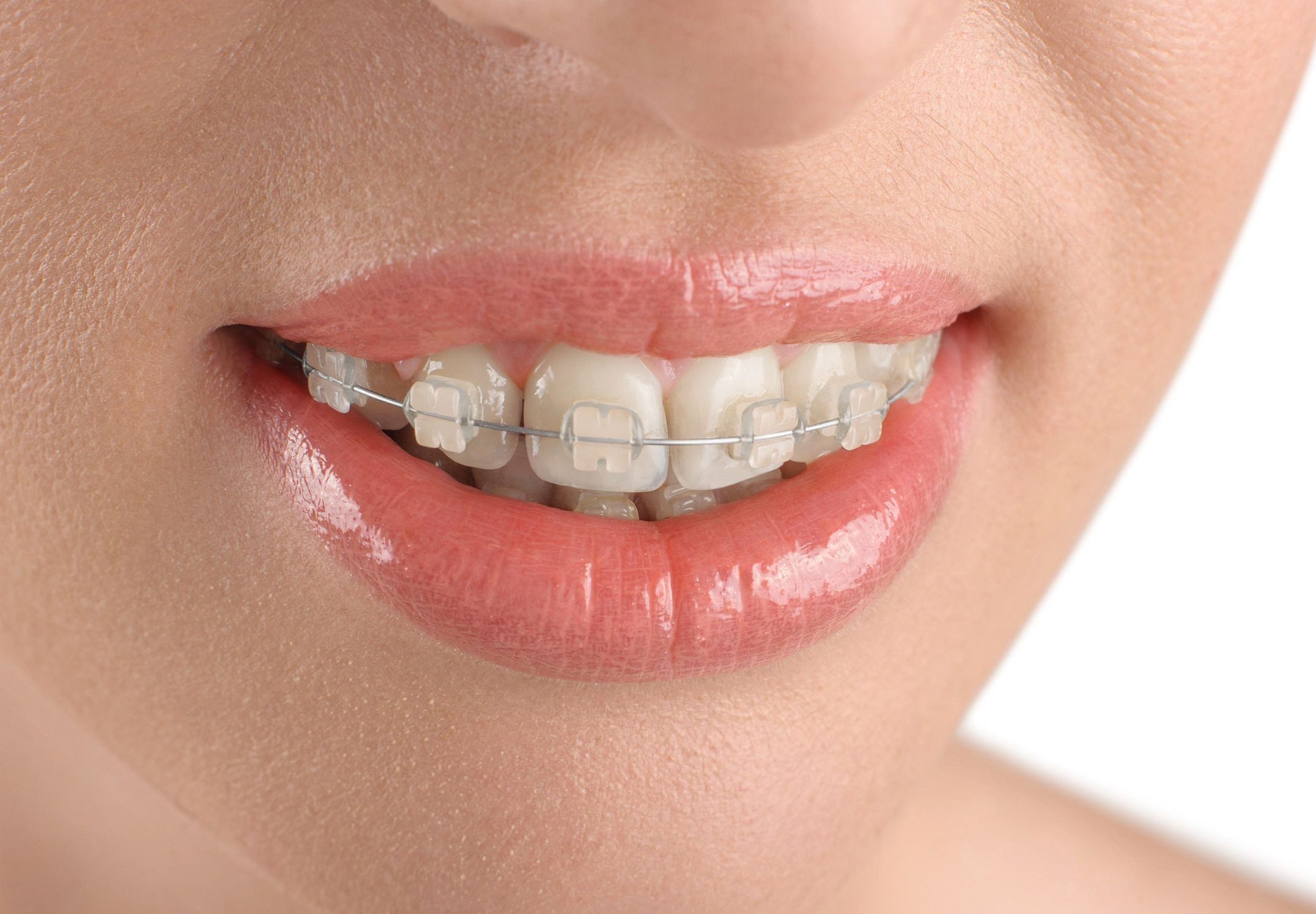 aparatos de ortodoncia