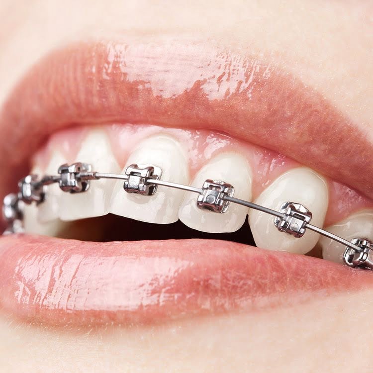 brackets autoligables