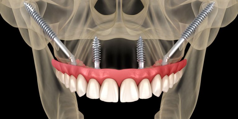 implantes cigomáticos