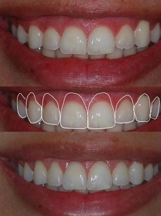 gingivectomia