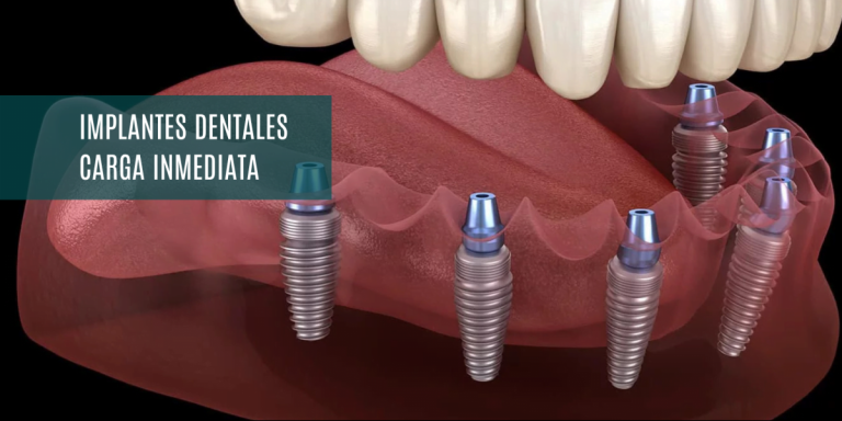implante carga inmediata