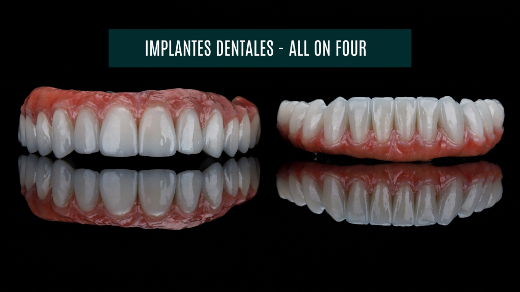 Dos prótesis de arcada completa para implantes con la técnica All on Four