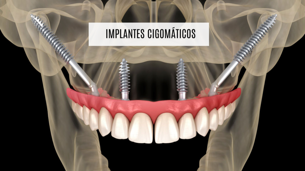 Ilustración de implantes cigomáticos anclados al hueso del pómulo que sujetan una prótesis