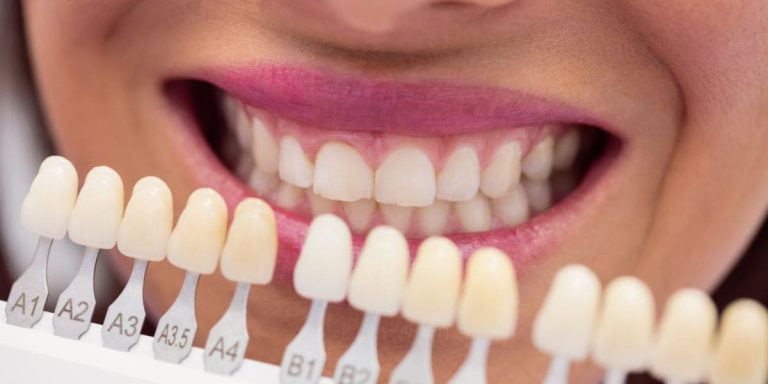 precio carillas dentales
