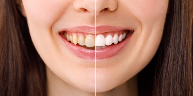tipos de blanqueamiento dental