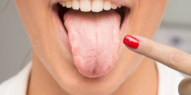 Lengua blanca: una mujer saca la lengua, cubierta por una capa blanquecina de candidiasis