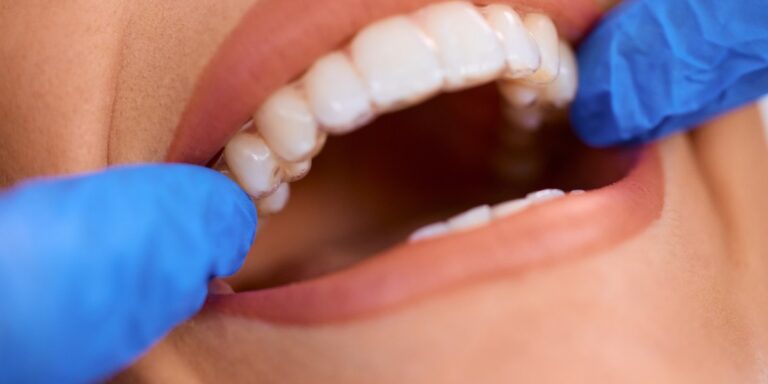 Ataches de Invisalign: qué son, para qué sirven, cómo se ponen y cómo se quitan