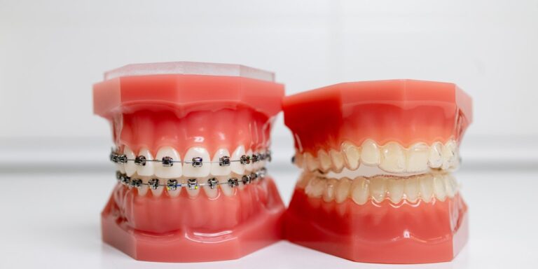¿Qué es mejor, brackets o Invisalign? Diferencias y de qué depende la elección