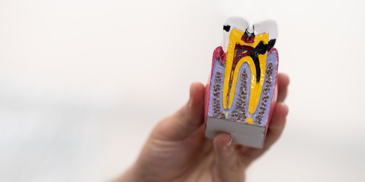 Caries en dientes de leche: mano de dentista que sostiene un modelo de plástico de un diente humano afectado por caries sobre fondo claro