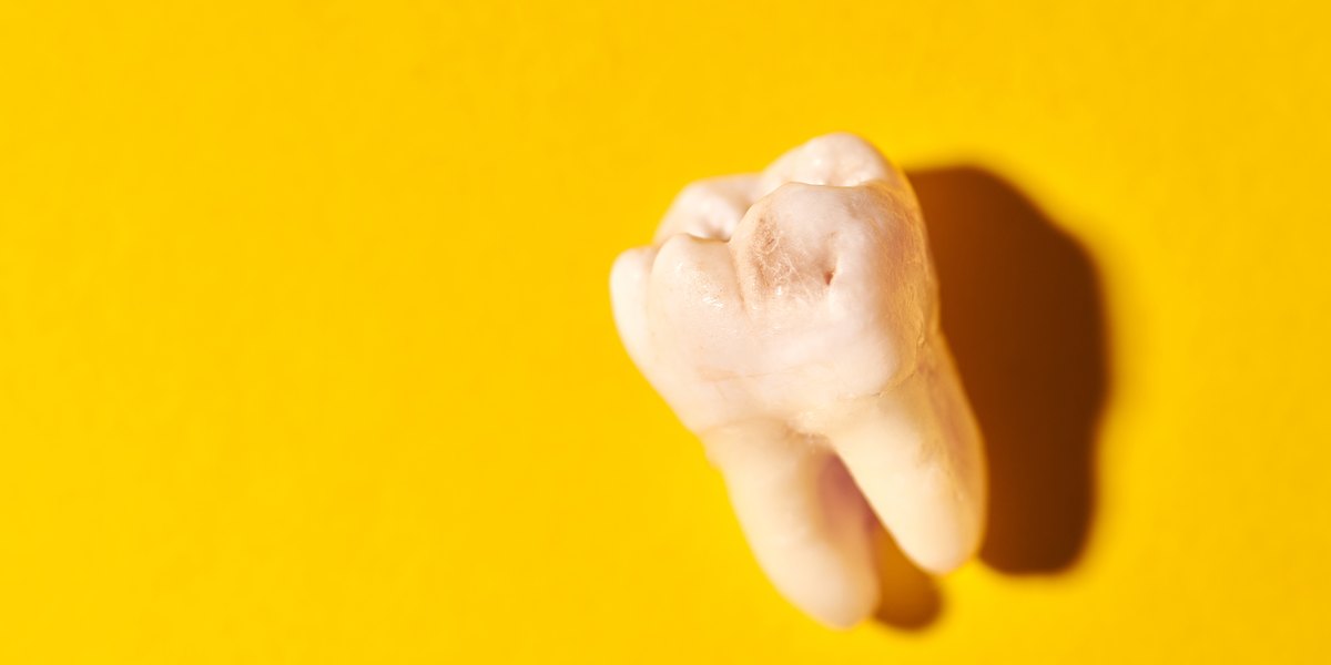 Caries inicial: muela extraída con sus raíces sobre fondo amarillo, con las fisuras de la cara de masticar oscurecidas