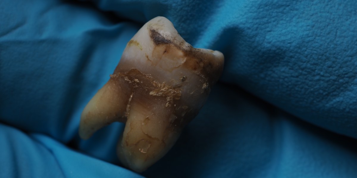Caries interproximal: muela extraída sujeta con guante, con la caries oscura en la cara lateral junto al cuello del diente