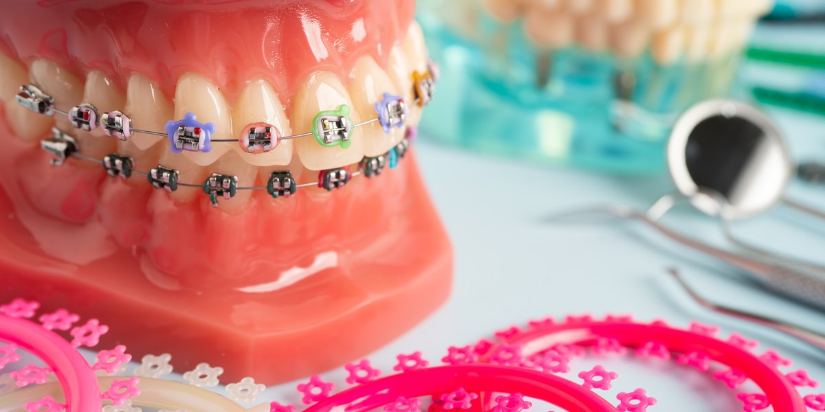 Cera y gomas de brackets: modelo de dientes con brackets metálicos y gomas de colores junto a tiras de ligas