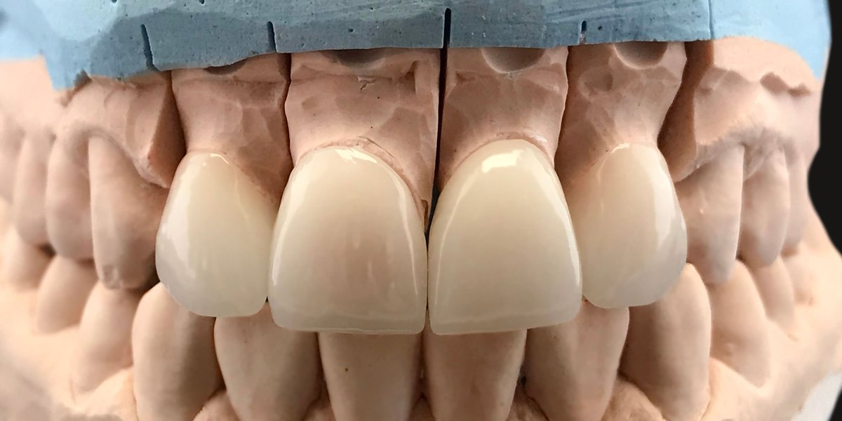 Corona dental: cuatro coronas de cerámica de los dientes delanteros sobre un modelo de escayola