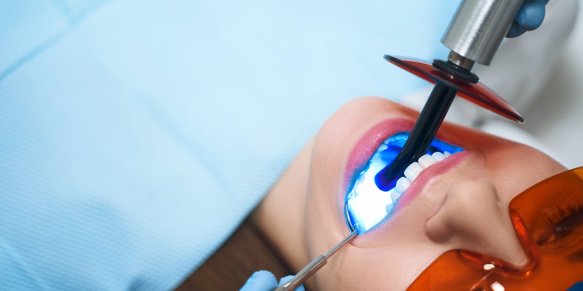 Diente roto: el dentista endurece con la lámpara de luz azul una reconstrucción de resina