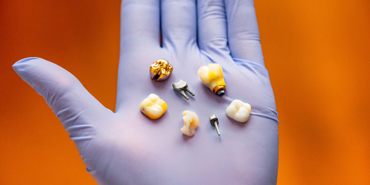 Dientes de oro: una corona de oro de muela junto a coronas de cerámica, un muñón metálico y piezas de implante sobre la palma de un guante