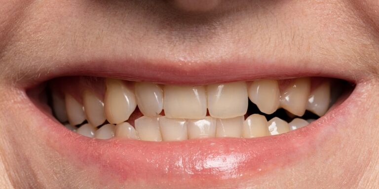 Dientes separados (diastema): por qué se separan y cómo se cierran los huecos