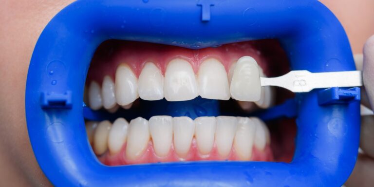 Dientes de tetraciclina: por qué se manchan y cómo se tratan las manchas