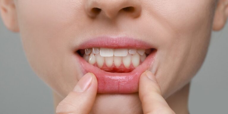 Encías retraídas: una mujer se baja el labio inferior y deja ver la encía y el cuello de los dientes