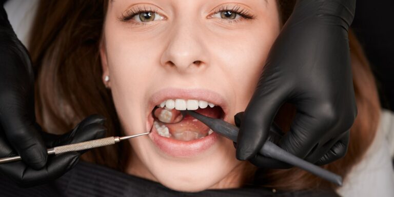 Fístula dental: el granito de pus en la encía, por qué sale y cómo se cura
