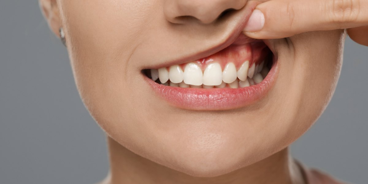 Gingivitis: una mujer se levanta el labio y enseña la encía sobre los dientes