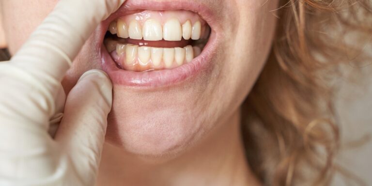 Hipoplasia dental: qué es, causas y tratamiento en niños y adultos