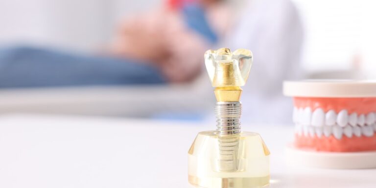 Implantes dentales sin tornillo: qué son de verdad y qué alternativas existen