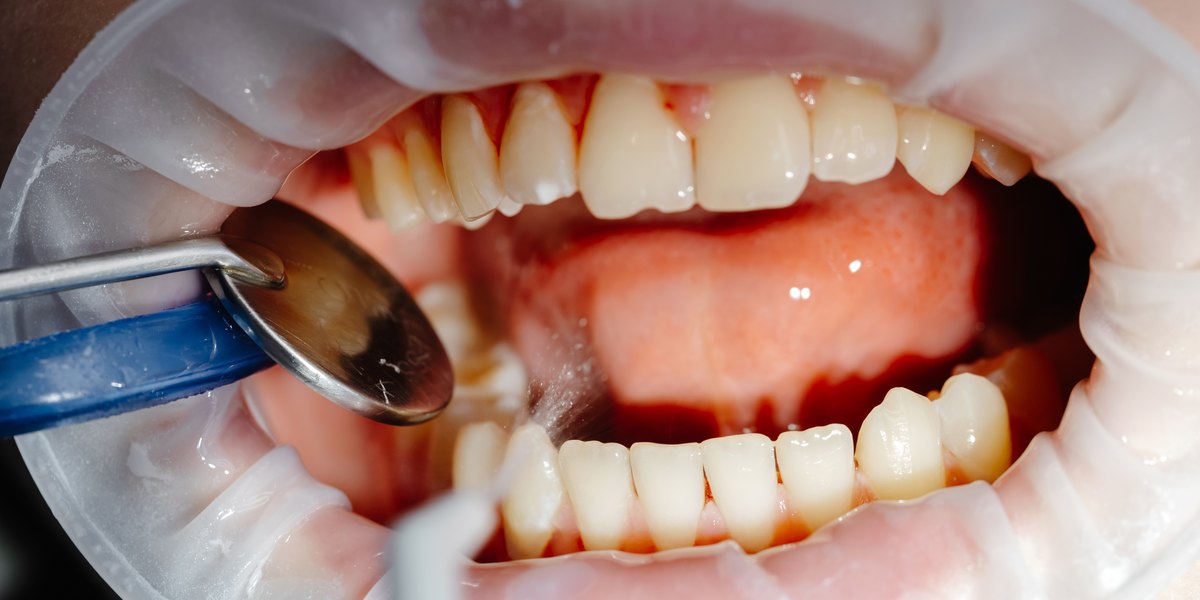 Limpieza dental: boca abierta con separador mientras el espejo aparta la mejilla y la punta del instrumento limpia junto a los dientes inferiores