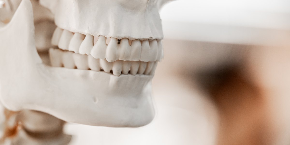 Máscara facial de ortodoncia: maxilar superior y mandíbula de un modelo de cráneo, de perfil y en mordida