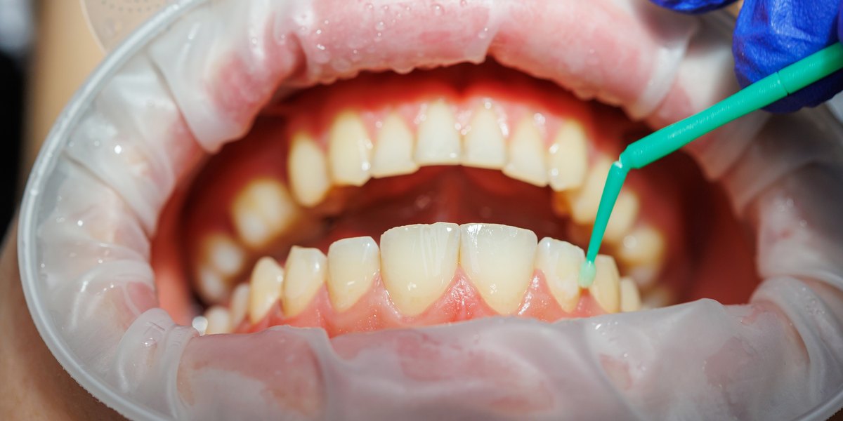 Periodoncista: boca abierta con separador de labios y el especialista apoya un aplicador fino en el borde de la encía inferior