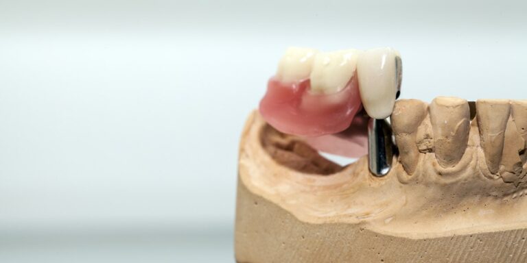 Puente dental: prótesis fija de tres dientes sobre un modelo de escayola, junto a un pilar metálico