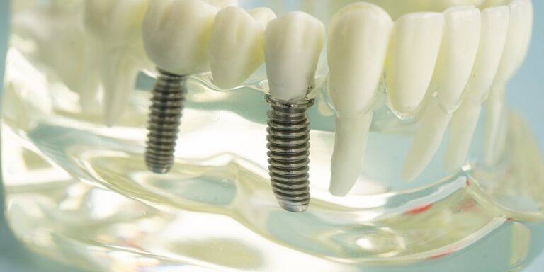 Sin dientes: qué pasa si no repones las piezas que faltan y qué opciones tienes